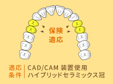 適応条件：CAD/CAM装置使用、ハイブリッドセラミックス冠