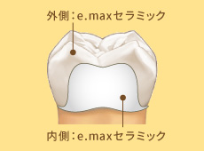 外側：e.maxセラミック、内側：e.maxセラミック