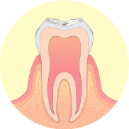 歯の表面にごく小さな虫歯ができます