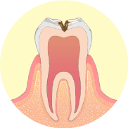 虫歯が神経に近くなり、冷たいものがしみます