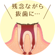 神経が死んでしまい、痛みを感じなくなります