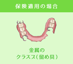 保険適用の場合金属のクラスプ（留め具）