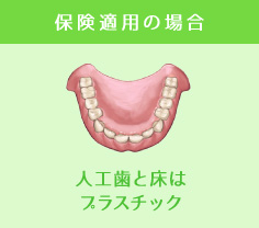 保険適用の場合人工歯と床はプラスチック