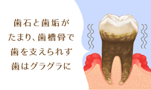 歯石と歯垢がたまり、歯槽骨で歯を支えられず歯はグラグラに