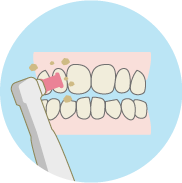 歯のクリーニング歯垢・歯石の除去